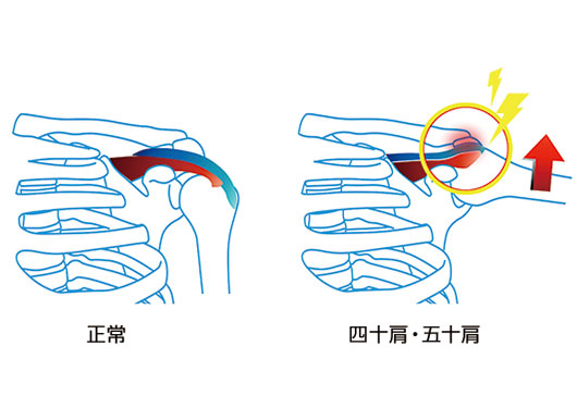 五十肩説明画像